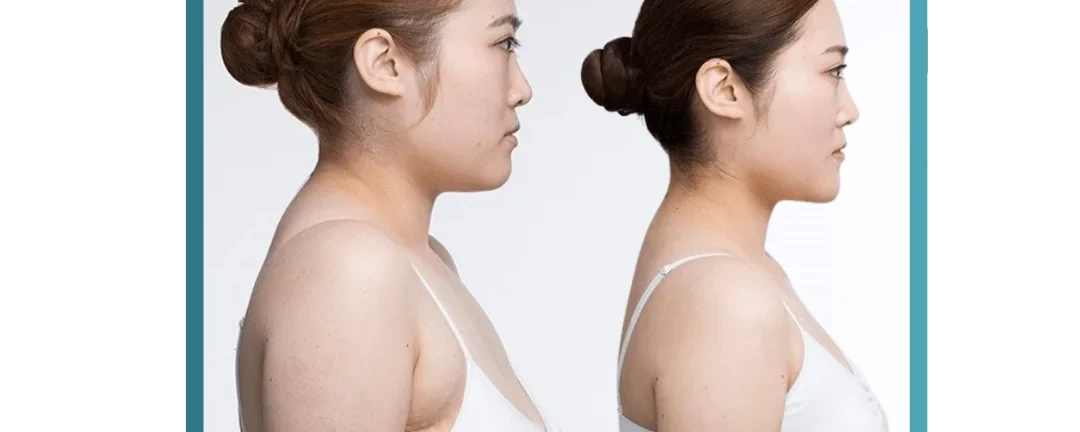 Everything You Need to Know About Breast Reduction in India