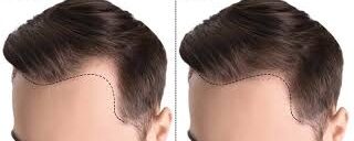 Hair Transplant for Men: Cost, Procedure & Recovery Explained